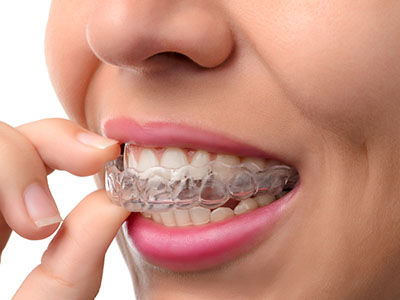 Clark Family Dentistry | Preventative Program, Invisalign reg  and Sports Mouthguards